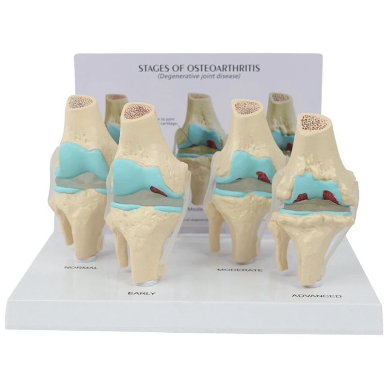 

Набор для колена, модель для остеоартрита с обучающей картой для ключей, 4-ступенчатая модель колена, ортопедические учебные пособия