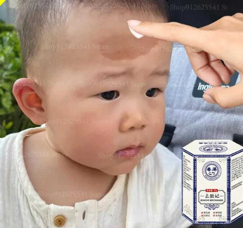 Birthmark Removal Cream Whitening Freckles Facial Spots Skin Dark Spot Remover Melanin Anti-Pigmentation Improve Dullness