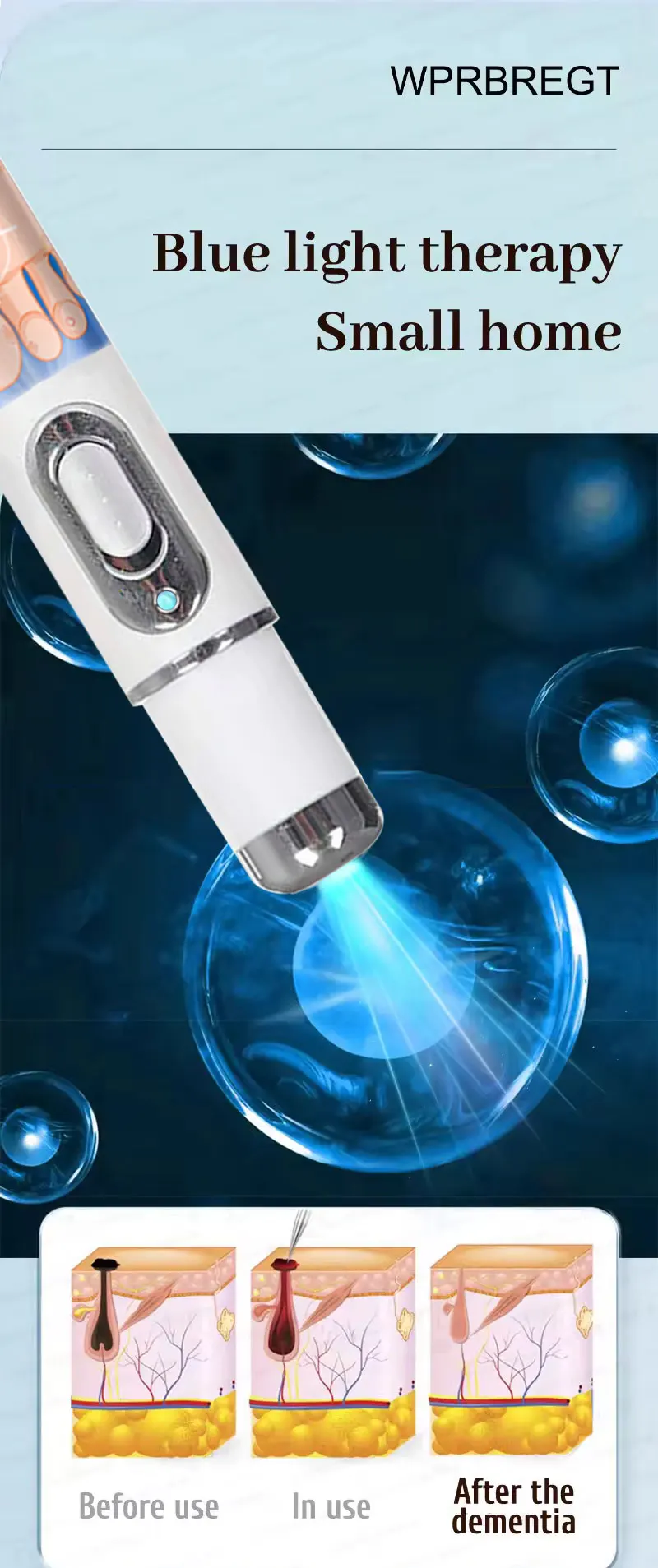 Penna a luce blu a massima potenza per la rimozione di verruche comuni e plantari, strumento per la cura delle verruche._voghion.com