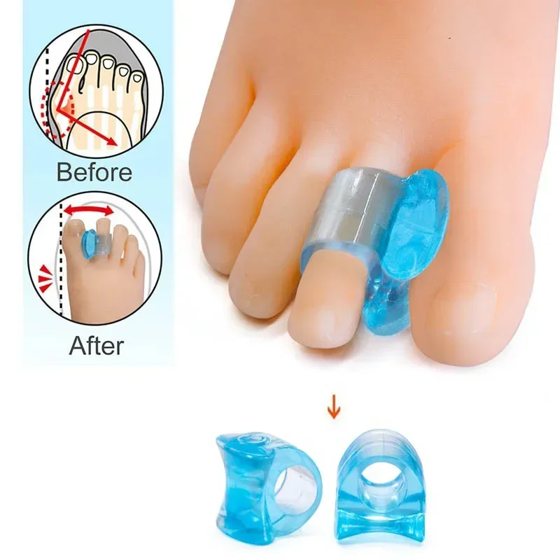 Delysia king Toe orthotics