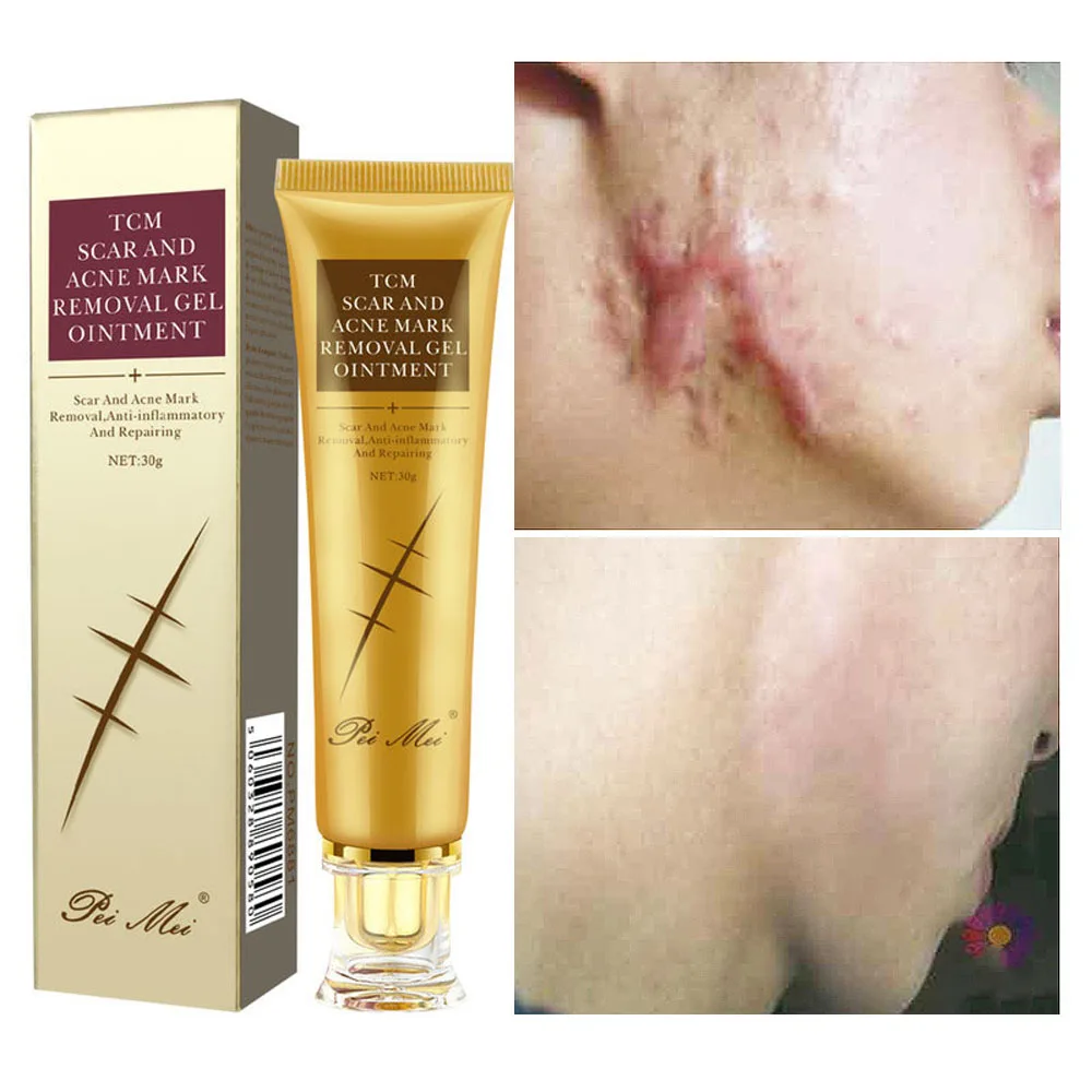 

Acne Scar Removal Cream Stretch MarksTreatment Skin Care Pimples Spots Repair Gel Whitening Moisturizer Smooth Beauty Cosmetics