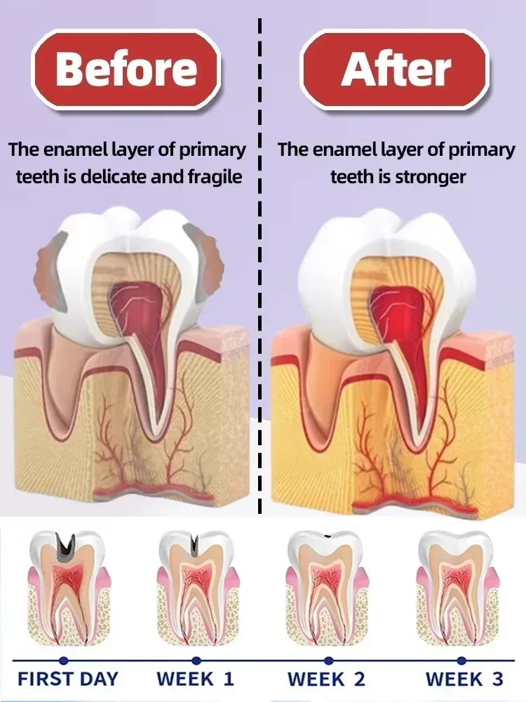 Anti Caries Repairing Cavities Tooth Decay Repair teeth health product