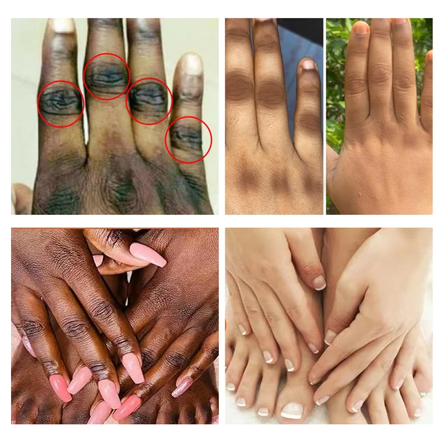 5D Gluta Szerves Vitamin E És Kollagén-Taches Hidratáló Test Csukló Fehérítő Szérum 125 Ml Sötét Foltokhoz - Image 4