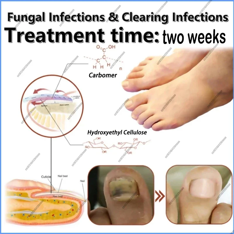 Fungal Nail Laser Device Repair Fast Nails Fungus Onychomycosis