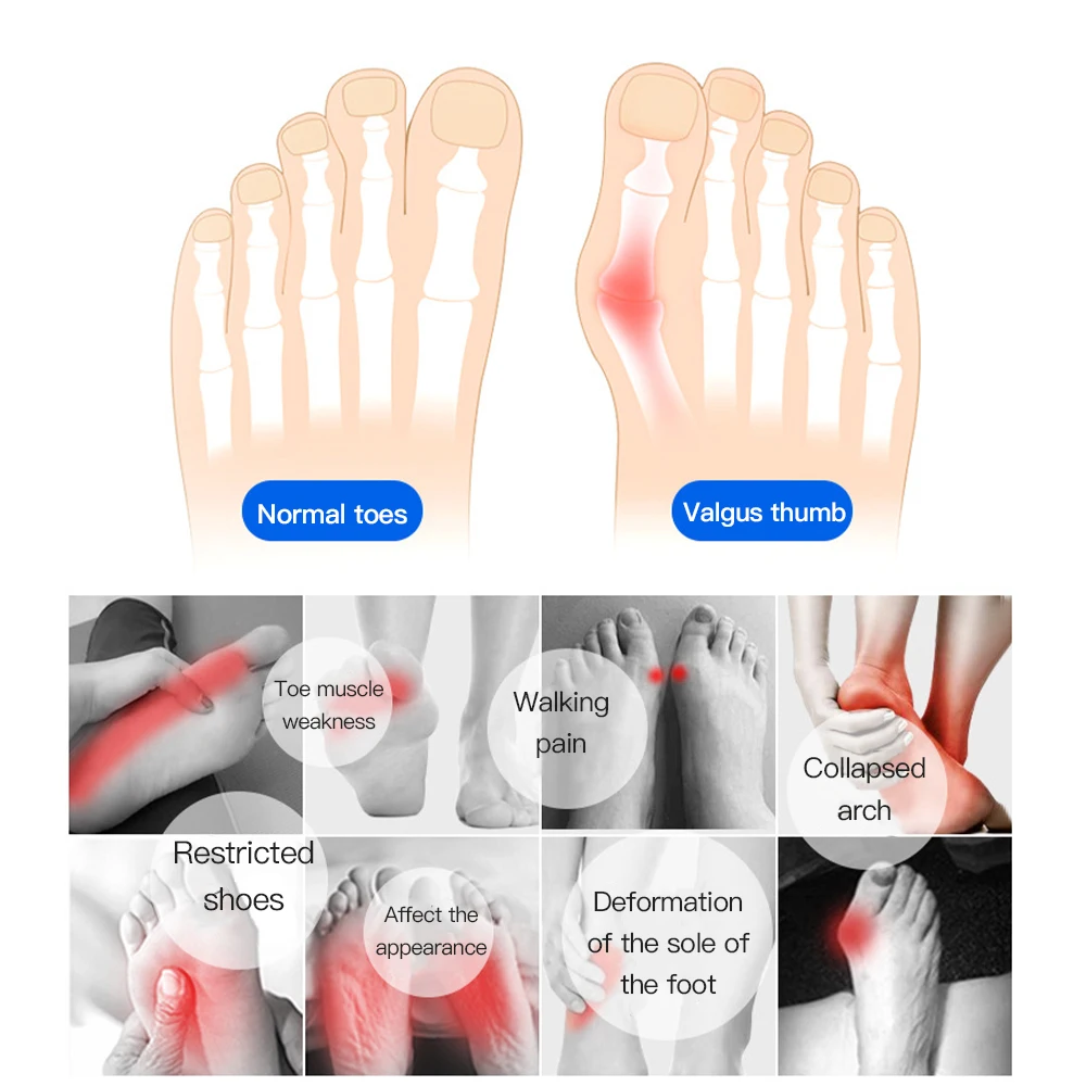    ߰ ܹ       ť 縻 Bunion , 2 