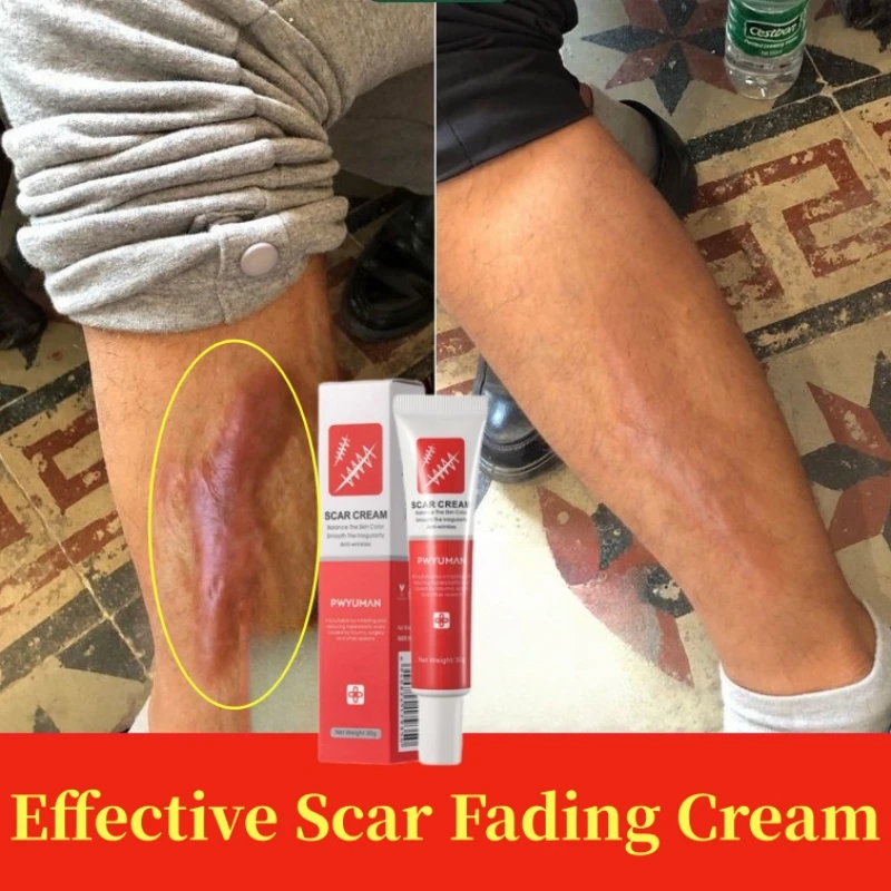

Fast Scar Removal Cream Effective Treatment Stretch Marks Burn Fade Acne Spots Section Scars Gel Whitening Smoothing Skin Care