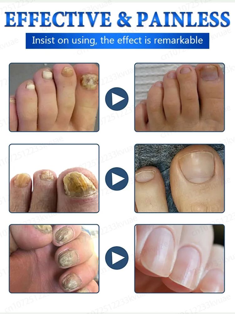 nail