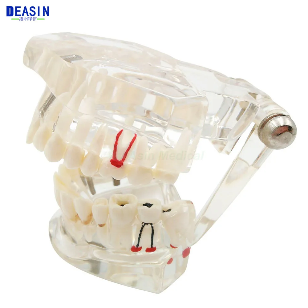 

Dental implant Demonstration Bracket Simulation Teeth Model teeth removable