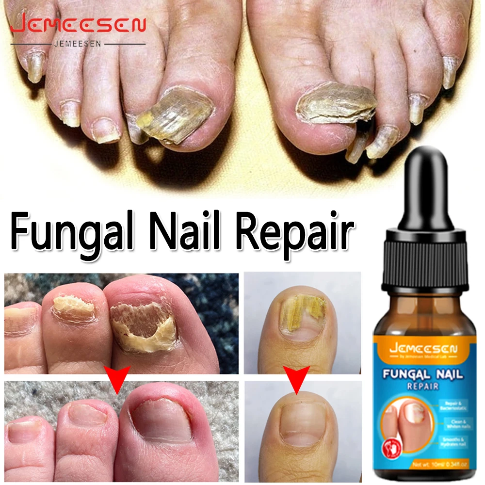 Discover 144+ gel nail fungus latest songngunhatanh.edu.vn