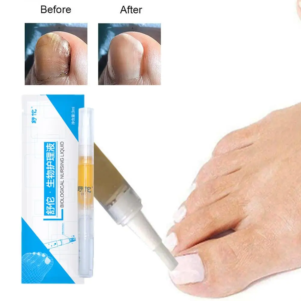 

Nail Fungus Treatment Essence Serum Care Hand And Foot Fungus Removal Gel Nail Care Removal Gel Anti-infective 3ml Repair D9O0