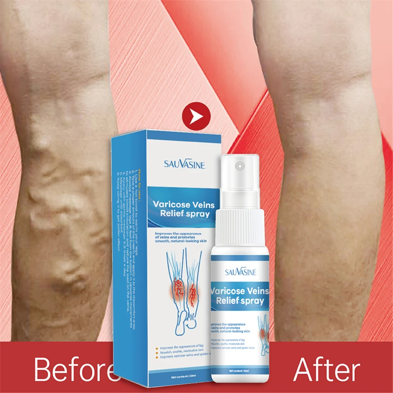 VaricoseVeinsReliefSprayVasculitisPhlebitisSpiderPainRelief