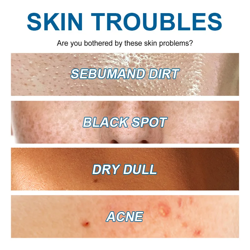 Oligopeptide Anti Acne Face Serum EGF Acne Treatment Essence Diminish Pigmentation Moisturizing Skincare Repair Skin Barrier 6