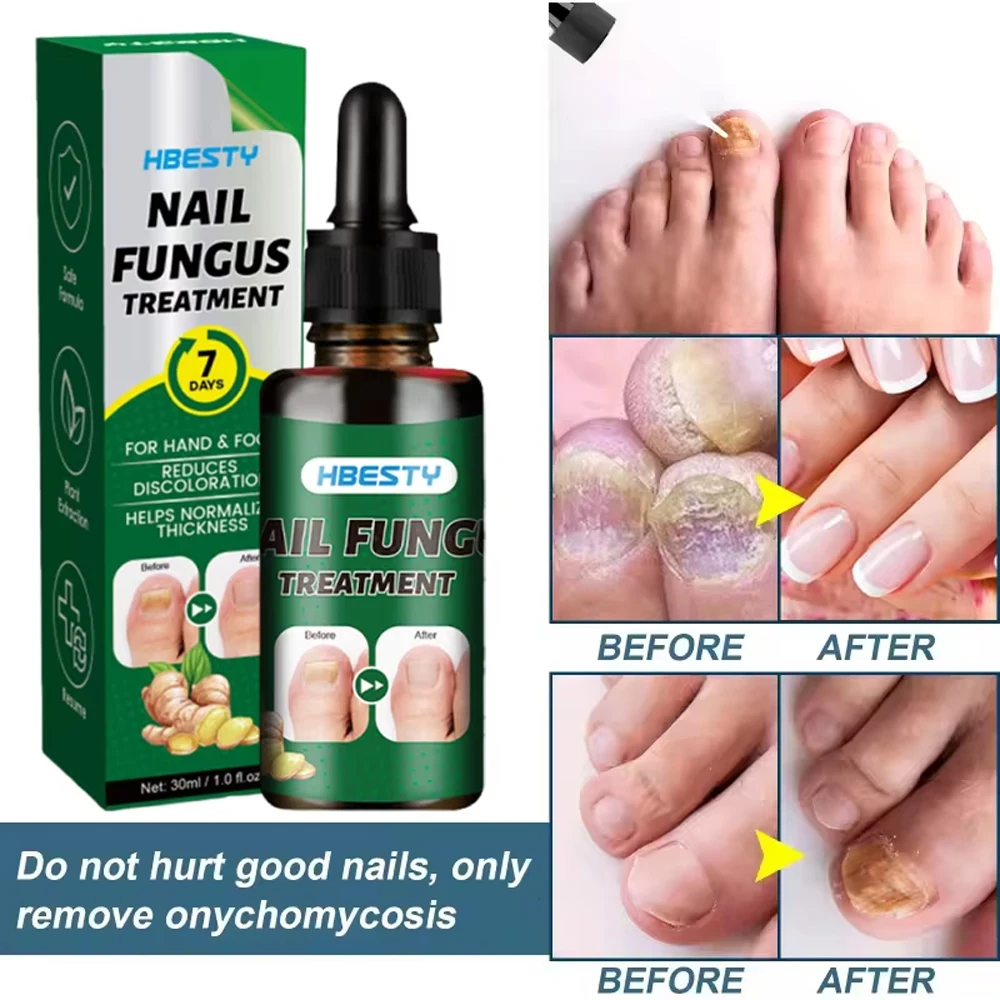 Nail Fungal Repair Serum Foot Toe Nail Fungus Removal Essential Oil Anti Infection Onychomycosis Paronychia Repairing Care