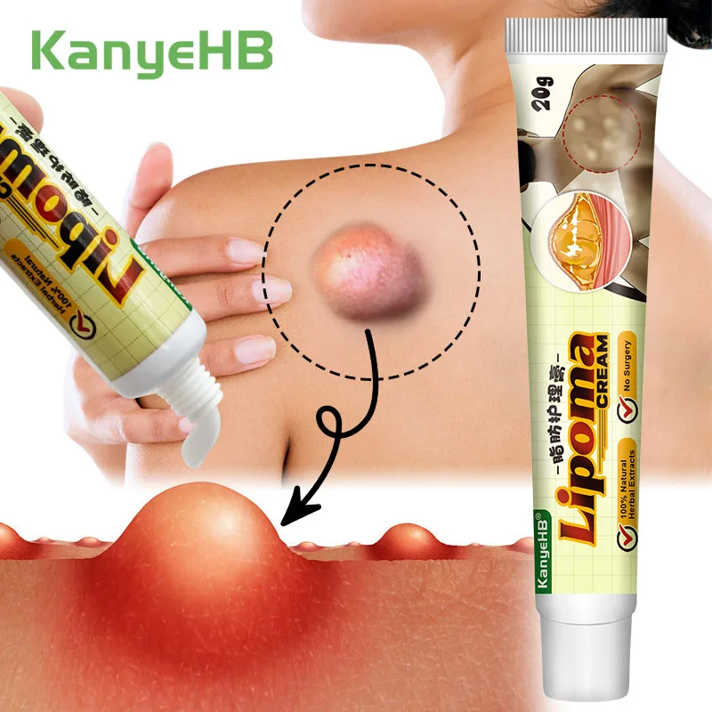 Lipoma Removal Cream Removes Lipoma Fibroids Herbal Skin Swelling Cellulite Ointment Tumor Exfoliating Health Care 1Pcs lipoma removal cream lipoma removal patch