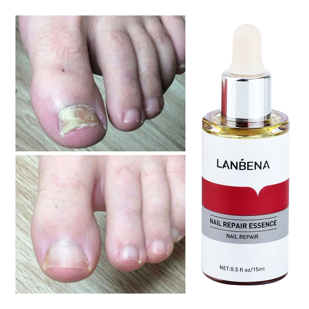 LANBENA Fungal Nail Repair Essence Serum Care Treatment Foot Nail
