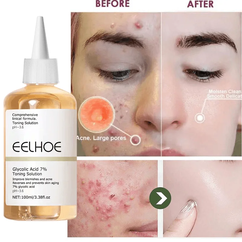 100ml Ethanoic Acid Acne Removal Serum Pore Shrink Essence Exfoliation