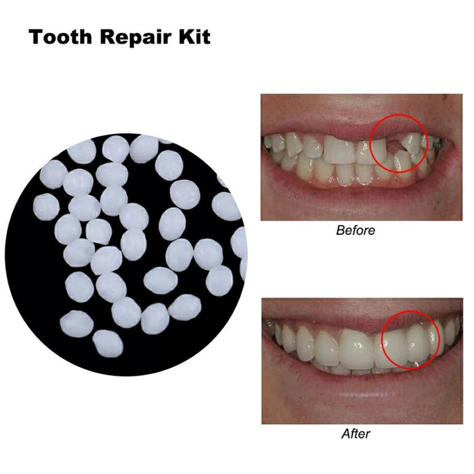 Kit De Reparación De Relleno Dental Temporal, Dientes Postizos, Pegamento  Sólido, Cuentas De Reparación Dental Para Falta De Dientes Rotos Para  Mujeres Y Hombres De 11,15 €