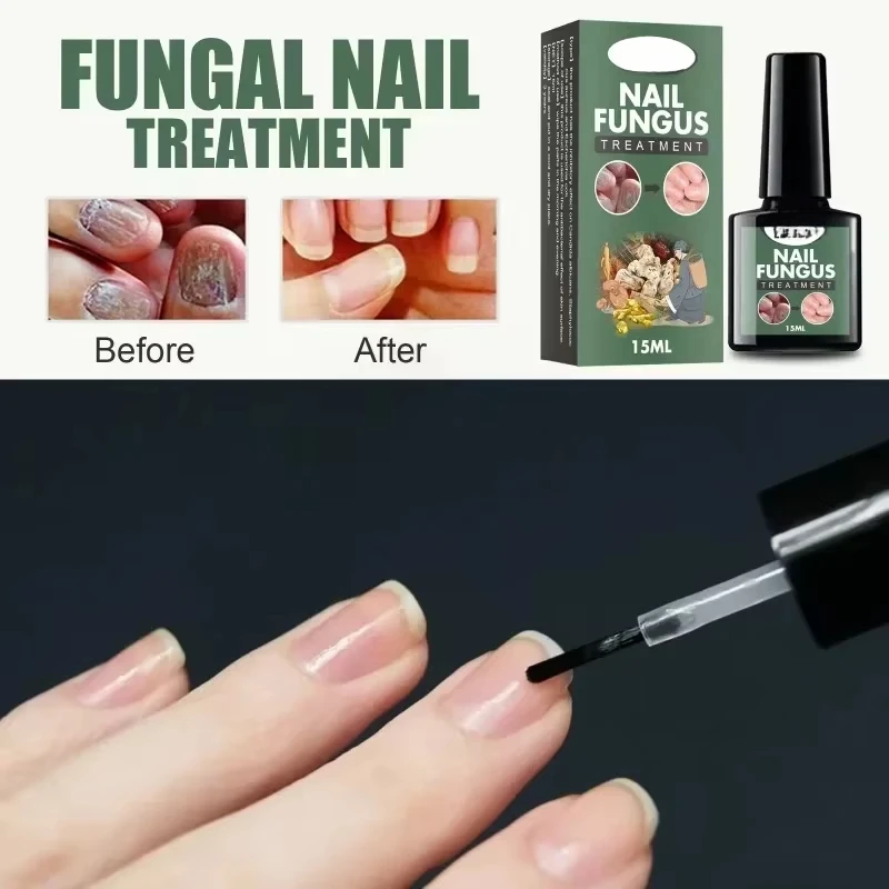 Nail Fungal Treatment Essence Oil Foot Toe Nail Fungus Removal Serum 7 Days Repair Onychomycosi Anti Infection Gel Care Products nail fungus remover