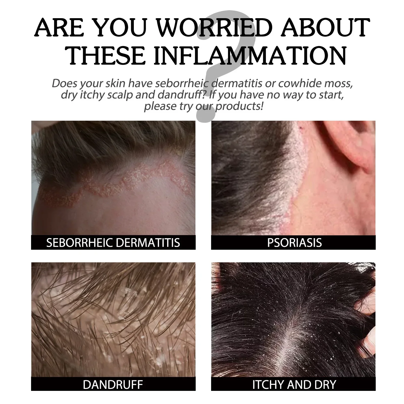 Psoriasis Treatment Serum for Scalp Head Acne Scalp Ringworm Treatments Repair Moss Reduce Dandruff Head Skin Care Roller