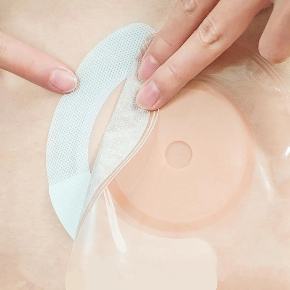 20pcs/lot Portable Ostomy Care Fix Tape Spunlaced Tapes To Fix Your Colostomy Bags Prevent Flange From Warping and Shifting 4