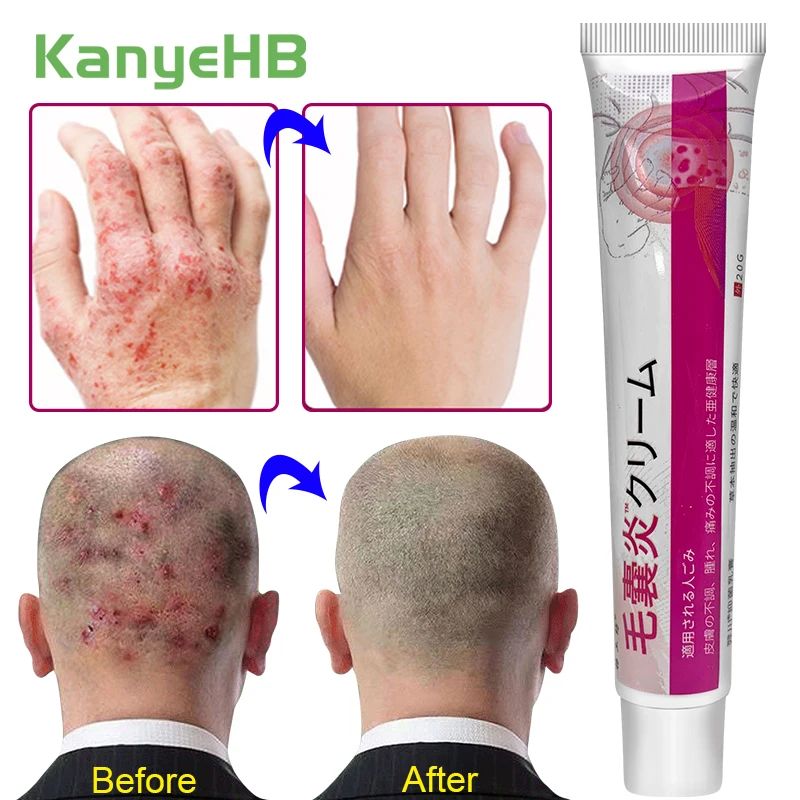 

1Pcs Herbal Acne Treatment Cream Skin Care Relief Folliculitis Psoriasis Skin Rash Anti-itch Anti Fungal Infection Ointment S115