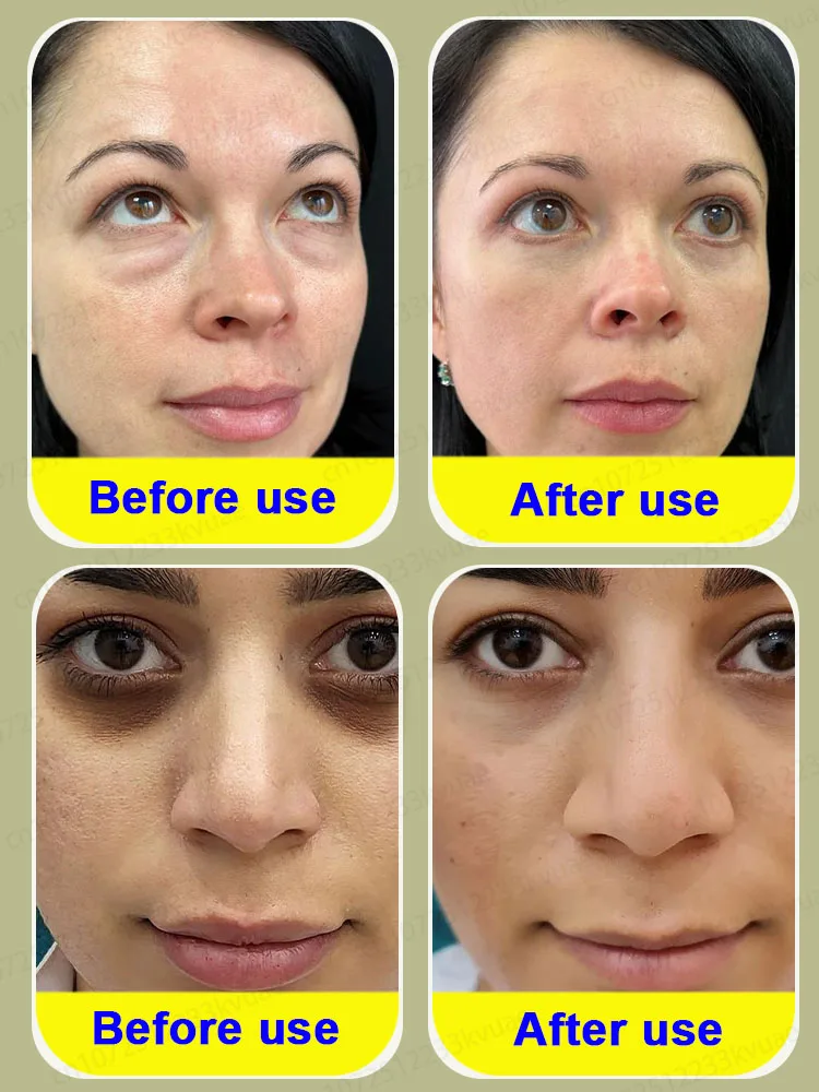 Eye Bag Killer Eliminates 99.9% of eye bags with centella asiatica and aloevera extracts to improve the skin around the eyes