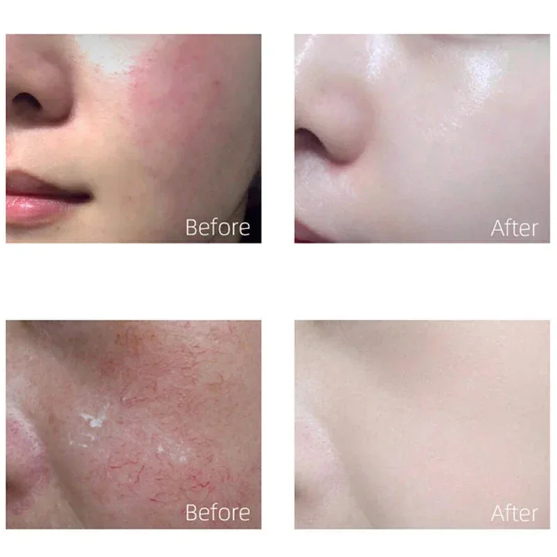 Repair Redness Serum Sooth Itching Sensitive Skin Improve Rosacea Shrink Pore Smooth Nourish Facial Skin