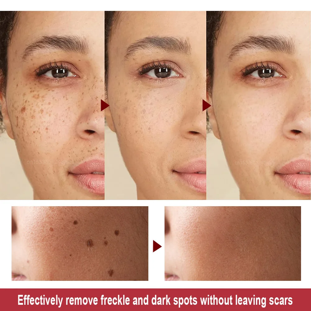 Manchas Oscuras DepilaciÃ³n LÃ¡ser En La Cara Consecuencias Laser