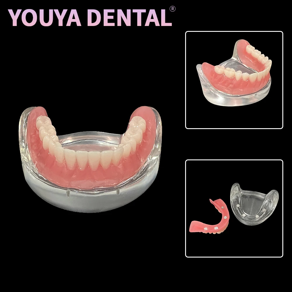 

Модель зубного импланта со съемным мостом, 4 имплантата, верхзубной протез, демонстрационная модель мандибулярных зубов, обучающая модель зубов