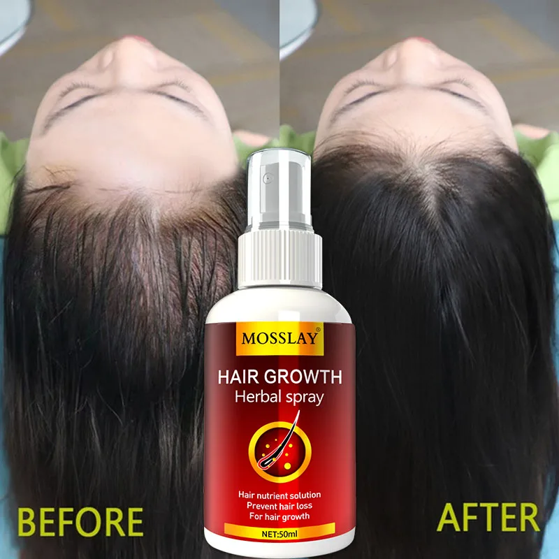 Hair Growth Serum Spray Fast Hair Growth Liquid Treatment Scalp Hair