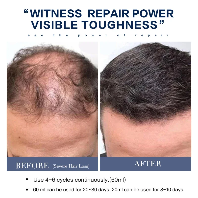 Anti Hair Loss Serum Damaged Nourish Fast Growing Essence Oil Spray Shampoo Hair Care Thickner Prevent Baldness