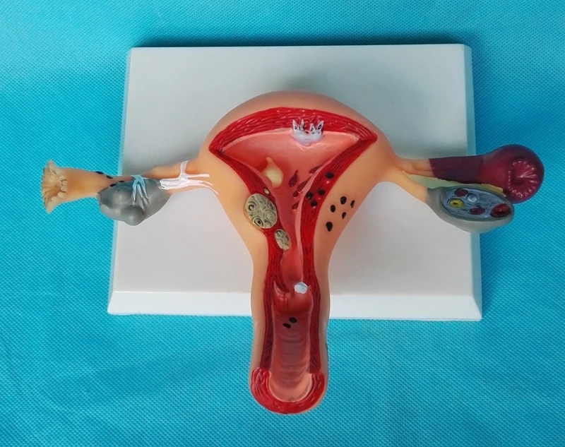 weibliches-patho-logisches-uterus-erkl-rung-modell-anatomische