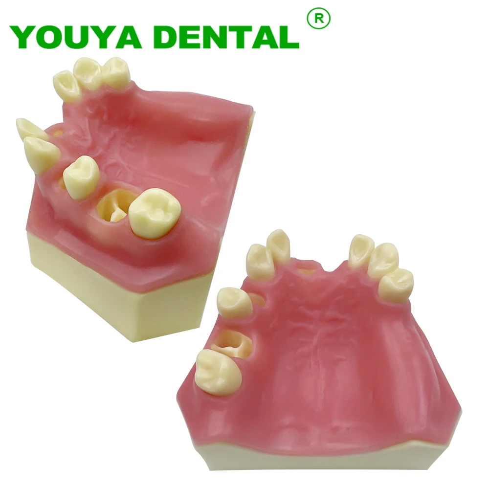 

Dental Implant Teeth Model Maxillary Sinus Implantation Practice Model With Missing Tooth Dentist Demonstration Tool Dentistry