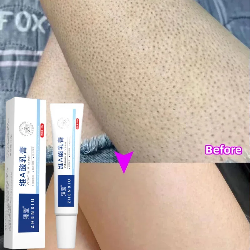 Body Whitening Cream Keratosis Pilaris Treatment Bumpy Rough Chicken Follicle Skin Repair Strawberry Legs Removal Dry Skin Care скраб для тела клубника wokali strawberry sherbet body scrub 500 мл