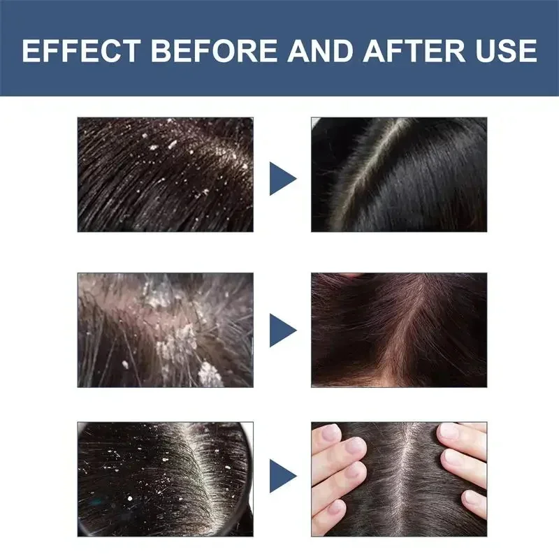 Hair Scalp Treatment Essence Spray Dandruff Itching Oil Control Anti Loss Scalp Cleaning Repair Serum Beauty Hair Care Products hair treatment scalp treatment
