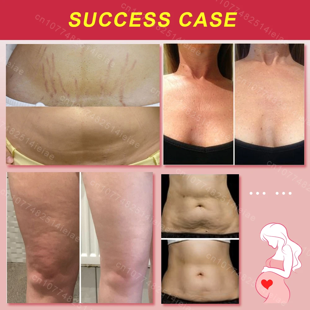 Pregnancy Mark Removal Cream Permanent Repairs Damaged Skin Natural Ingredients Remove Abdominal Pregnancy Line Without Stains