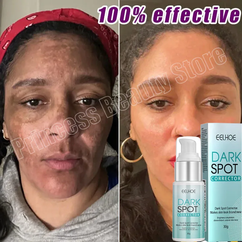 Whitening Body Cream Effective Whitening Freckle Cream Remove Dark Spot Lotion Removal Melanin Melasma Lighten Brighten Anti-Aging Skin Care Products,facial cream