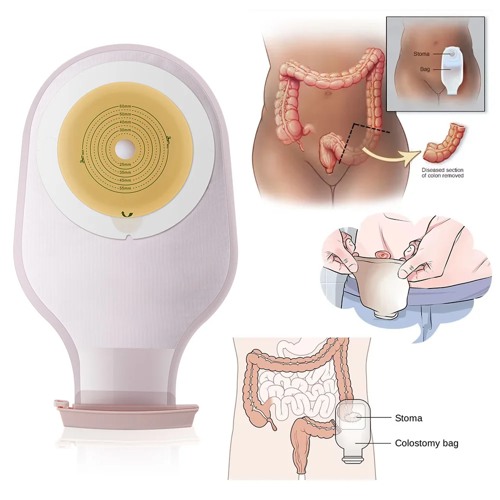 10pcs Colostomy Bags One-piece System Disposable Opening 20-60mm With Clip Closure