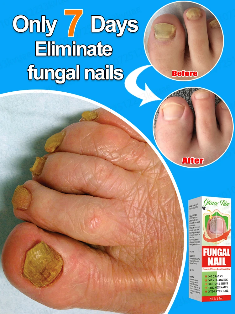Nail Fungus Oil Eliminates Various Nail Problems and Repairs Nails Fungus Solution