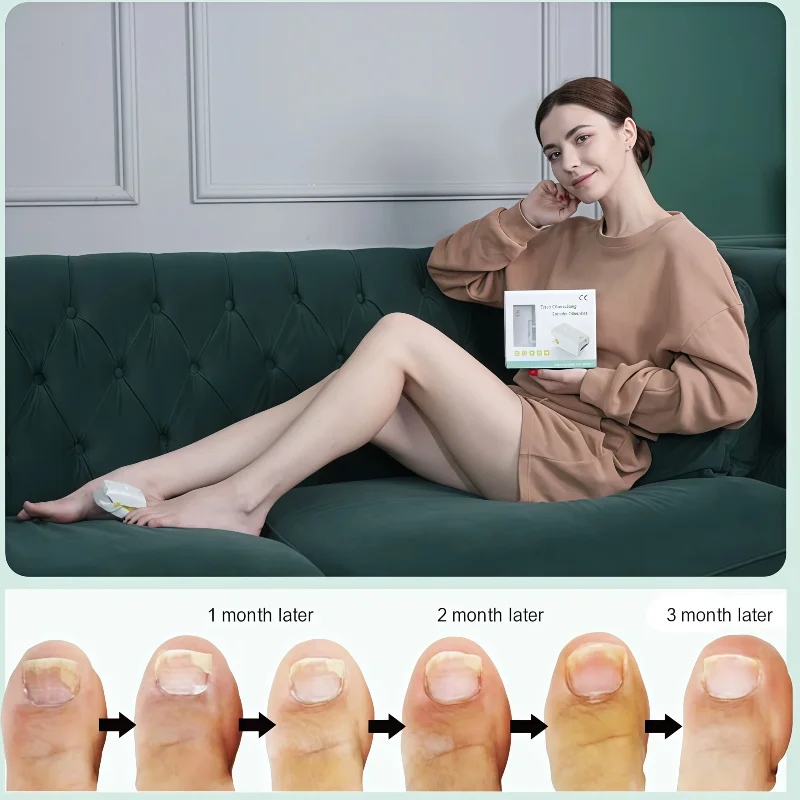 Onychomycosis Laser Treatment Device, 905nm 470nm Nail Fungus Therapy for Fungal Nail Cure on Toenails and Fingernails