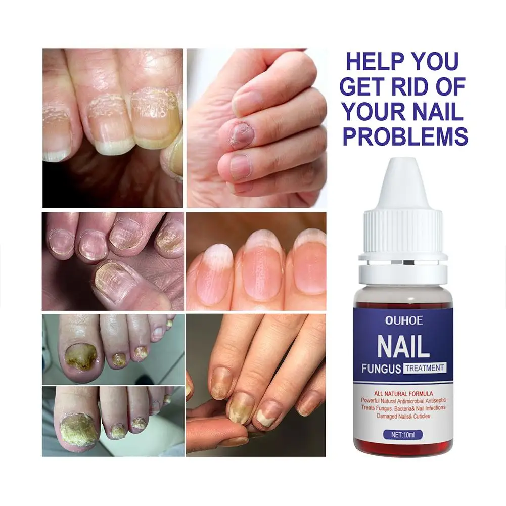 5PCS Nail Fungal Treatment Feet Care Essence Anti Infection Paronychia Onychomycosis Nail Repair Toe Fungus Serum Fungal Removal