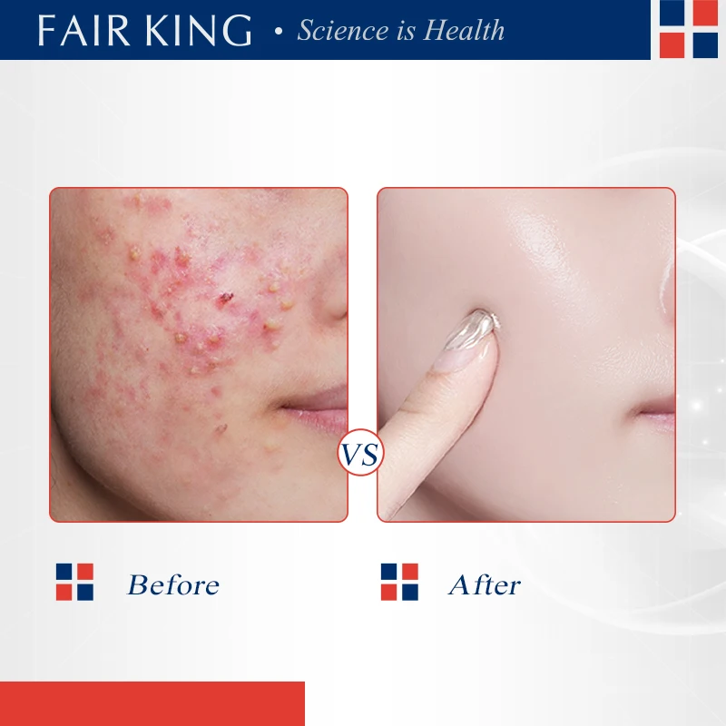 FAIRKING Tea Tree AcneCream Fade Pimples Skin CareScars Repair Removal Pore Shrinking Control Moisturizing Smoothing Skin Care