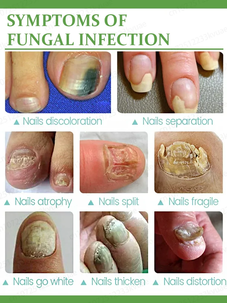nail