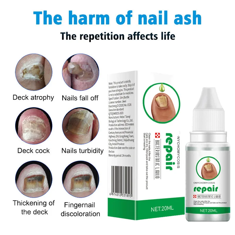 

Nail Fungus Treatment Serum Toe Fungal Repair Products Hand Foot Care Removal Gel Anti Infection Onychomycosis Paronychia