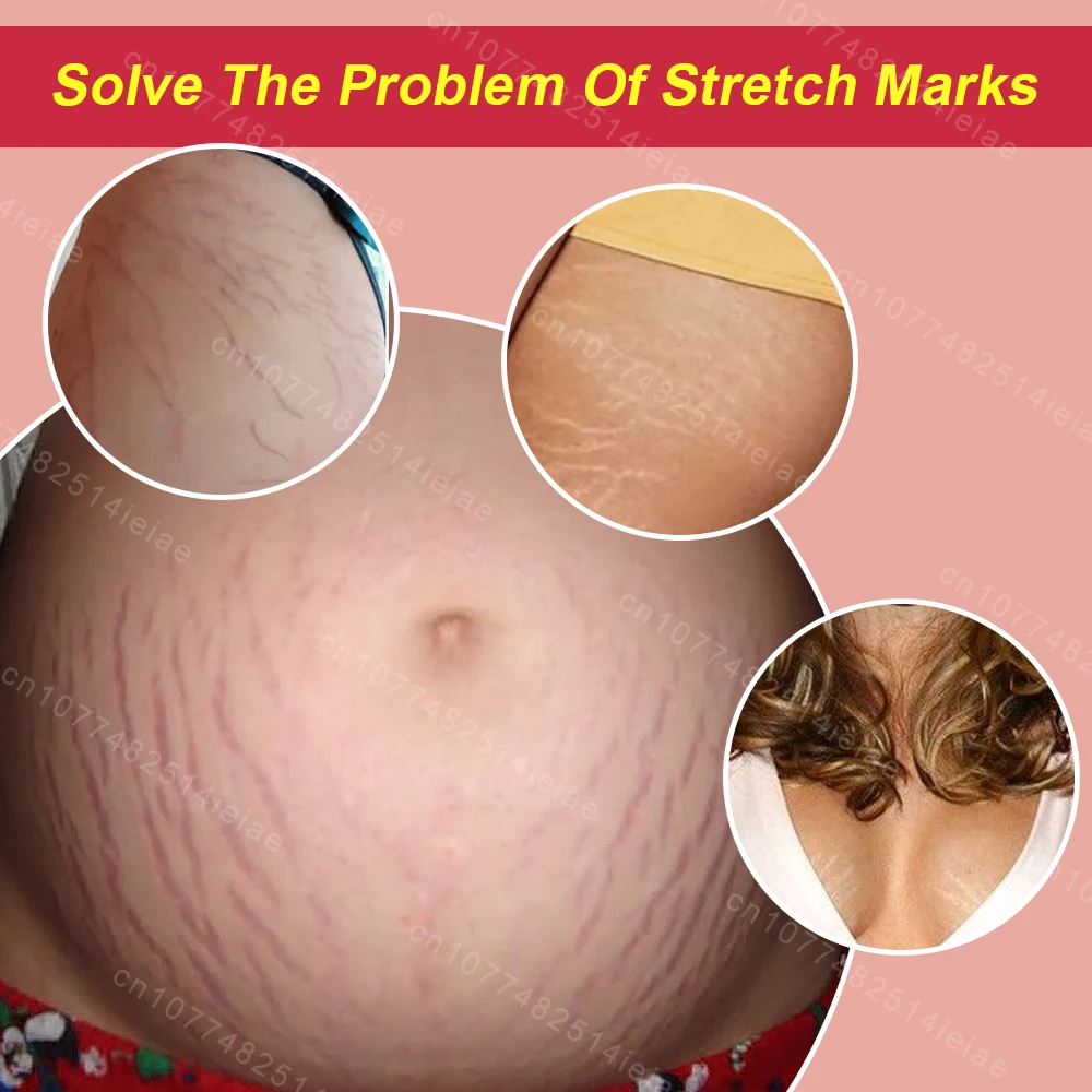 Pregnancy Mark Removal Cream Permanent Repairs Damaged Skin Natural Ingredients Remove Abdominal Pregnancy Line Without Stains