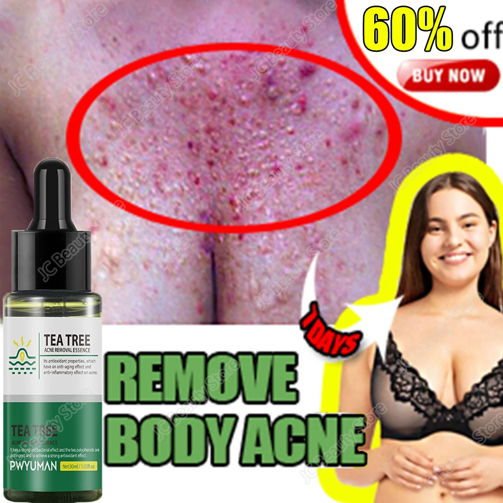 

Tea Tree Oil Acne Treatment Serum Remove Blackhead Pimple Acne Scar Treatment Essence Cream Shrink Pores Skin Care Cosmetics