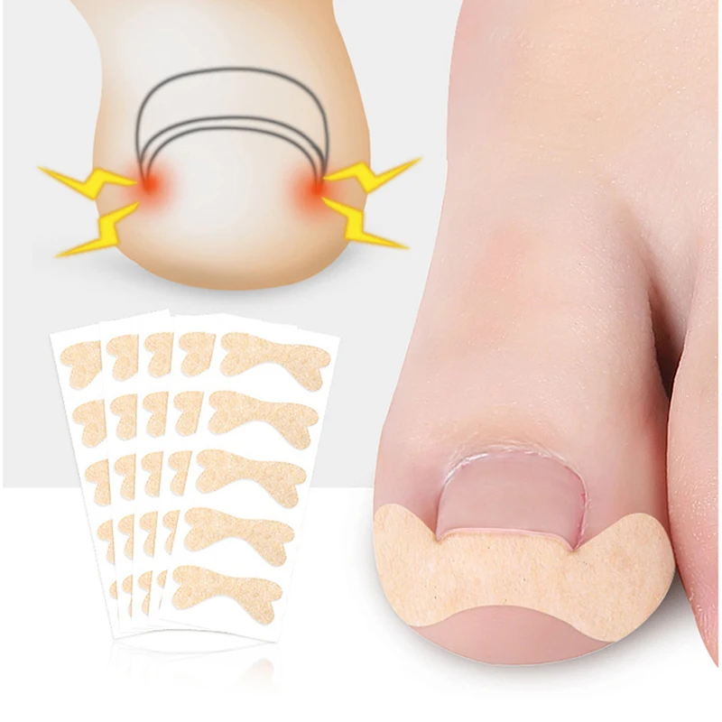 Correttore dell'unghia incarnita adesivo correttore per unghie intarsio per dita dei piedi Patch per unghie trattamento paronichia recuperare adesivi per la correzione del correttore