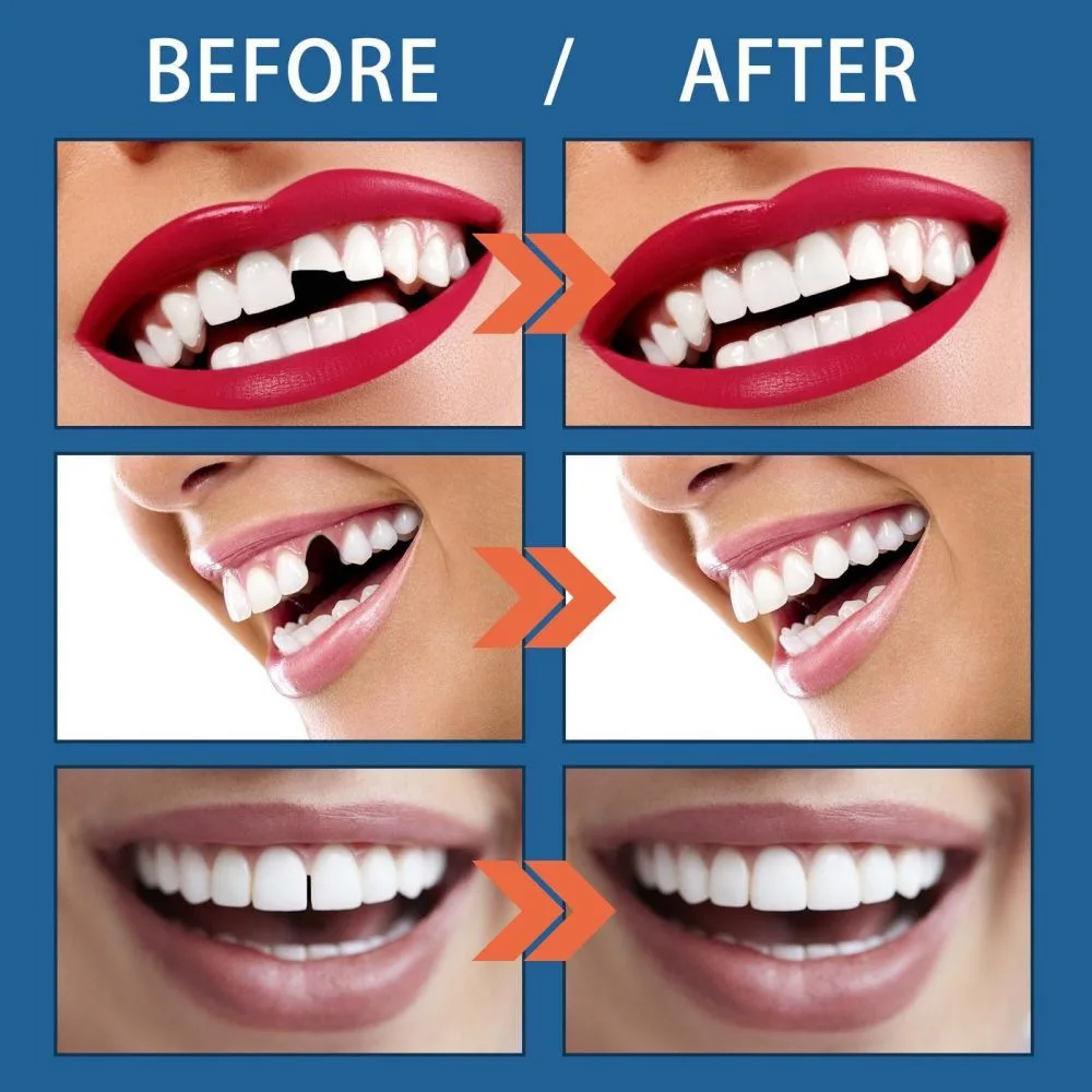 Resin Tooth Repair Glue Shapeable Teeth Gaps Filling Solid Glue Temporary Teeth Repair Falseteeth Safety Dental denture adhesive
