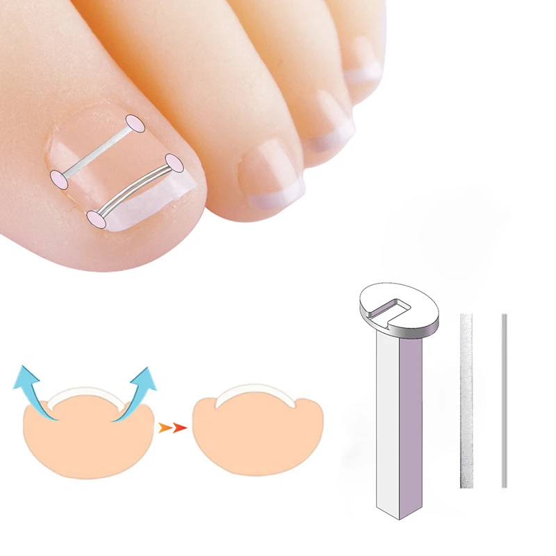 

Ingrown Toenail Corrector Tools Pedicure Recover Embed Toe Nail Treatment Professional Ingrown Toenail Correction Foot Care Tool