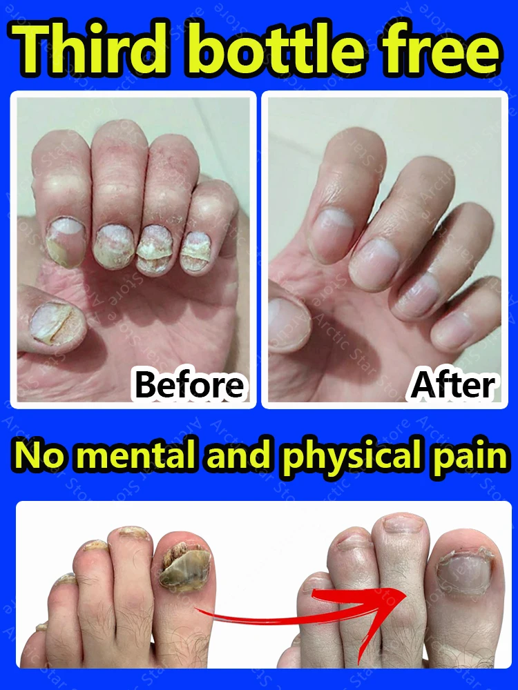 

Nail fungal drops Anti-infective onychomycosis Fungus nails